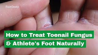 How to Treat Toenail Fungus amp Athletes Foot Naturally [upl. by Esylla]