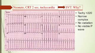 ECG Reading 7 د عمر الجنيد [upl. by Elmajian993]