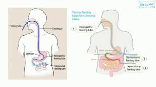 ileus [upl. by Alessig876]