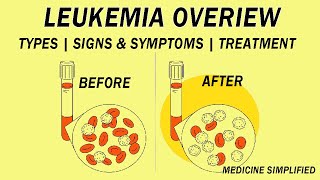 What is Leukemia  Classification Etiology Pathophysiology Clinical Features and Treatment [upl. by Harle]