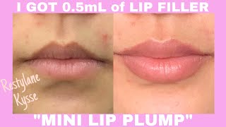 GETTING LIP FILLER FOR THE FIRST TIME  05mL Restylane Kysse mini lip filler [upl. by Ahseek]