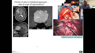 Tuberculum sellae meningiomas [upl. by Ariamat]