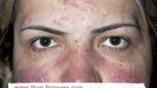 Rosacea Pictures [upl. by Jarrid]