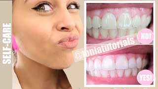 How I whitened my VERY yellow teeth WORKS BEFORE AND AFTER [upl. by Eidolem]