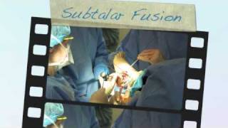 Subtalar Arthrodesis Surgical Technique Joint Exposure using the Tarsal Joint Distractor [upl. by Alaj]