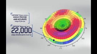 SILK vs SMILE vs CONTOURA VISION STREAMLIGHT  wwwLasikLaserorg contouravision lasik [upl. by Joao]