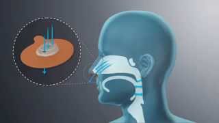 Provent Therapy An Alternative to CPAP for Sleep Apnea  DirectHomeMedicalcom [upl. by Elgna550]