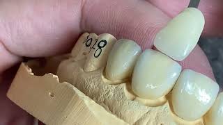 How to Make Full Shape Emax Veneers Look More Alive [upl. by Aihsik]