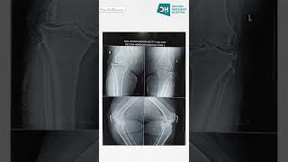 Bilateral Total Knee Arthroplasty  Patient Review  Deccan Hardikar Hospital [upl. by Enrobyalc]