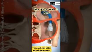 Transcatheter mitral Valve Replacement TMVR shorts [upl. by Skolnik]