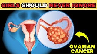 Ovarian Cancer symptoms [upl. by Ahsrat]