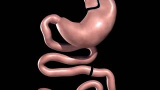 Roux en Y Gastric ByPass  Metabolic Bariatric Surgery animation [upl. by Hugues448]