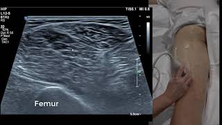 Hamstring Ultrasound 101 [upl. by Nivak]