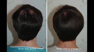 Haartransplantation mit FUE 1486 Grafts  Tonsur  deutsch [upl. by Dihsar]