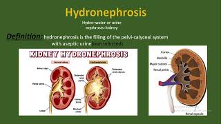 Hydronephrosis Definition causes and etiology pathology types diagnosis treatment [upl. by Eeruhs]