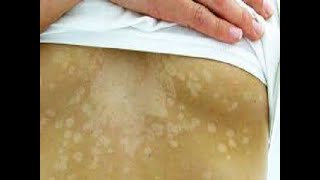 Tinea Versicolor Fungal infection Sehua का सही इलाज। Dr Sandesh Gupta Dermatologist [upl. by Bernardi]