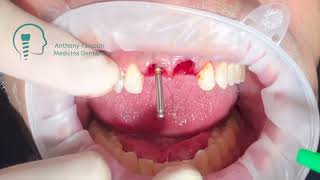 Exodontia  implantes imediatos no 11 e 21 FGM Arcsys [upl. by Cece]