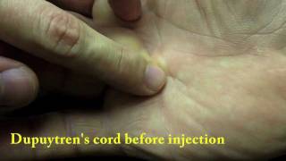 Xiaflex collagenase injection for Dupuytrens Finger Contracture [upl. by Hanoy]