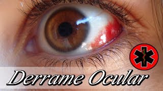 DERRAME OCULAR  Derrame en el Ojo 👁️  Sangre en el Ojo [upl. by Darcia882]