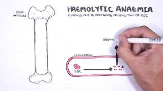 Haemolytic Anaemia  classification intravascular extravascular pathophysiology investigations [upl. by Vierno765]