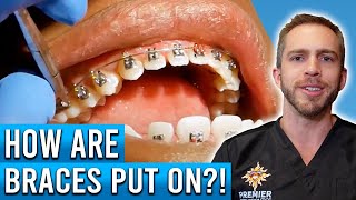 How Are Braces Put On [upl. by Bendix]