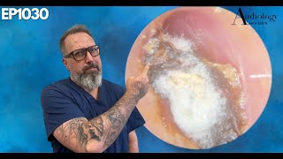 Deep Dry amp Difficult Furry Ear Wax Plug Removal  EP1030 [upl. by Rockwood886]