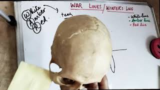 war lines  winters lines  impacted teeth [upl. by Tait]