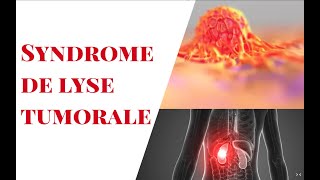 Syndrome de lyse Tumorale [upl. by Elleira]