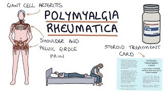 Polymyalgia Rheumatica Visual Explanation for Students [upl. by Leyameg]