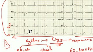 ECG  trouble du rythme et fréquence prt 1 [upl. by Faina]