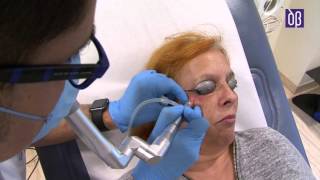 Eliminacion de siringomas milium y fibromas con laser [upl. by Kcirddes]