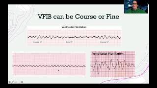 EKGVentricular Dysrhythmias [upl. by Isyed315]