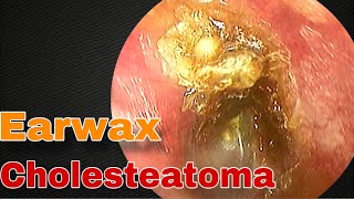 Earwax Sticks Lightly in Cholesteatoma Disease  Doctor Anh [upl. by Launcelot532]