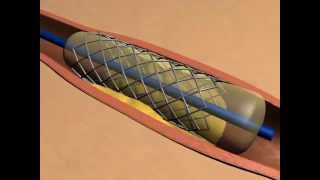 ballonnet et stent  angioplastie coronaire percutanée [upl. by Ananna]