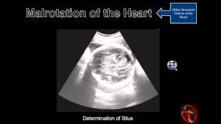 Fetal Echocardiography Malrotation [upl. by Naraa]