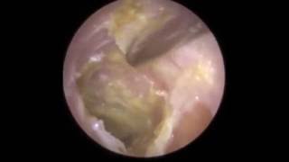 Infection of Eardrum visible after Hard Ear Wax Removal  Mr Neel Raithatha The Hear Clinic [upl. by Oer]