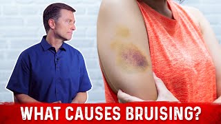 What Causes Bruising Without Trauma – Dr Berg [upl. by Ariak]