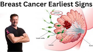 Earliest Signs of Breast Cancer Doctor Explains 2024 [upl. by Asilem]