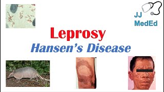 Leprosy Hansens disease  Who is at risk Signs and Symptoms Diagnosis and Treatment [upl. by Arihsa]