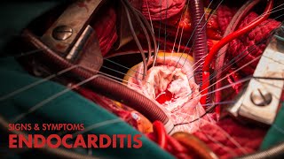 Signs and Symptoms of Endocarditis Mnemonic [upl. by Kariotta]