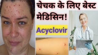 Acyclovir Tablet Uses In Hindi  Treatment For ChickenPox [upl. by Mariel93]