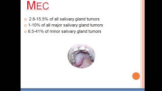 Mucoepidermoid Carcinoma 1 2024 [upl. by Kimmy]