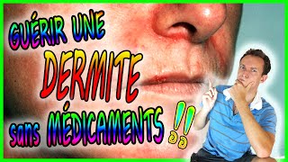 SOIGNER une DERMITE sans MÉDICAMENTS  102366 [upl. by Niwhsa]