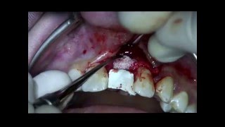 Step 4 Straumann BLT implant Placement Bone Augmentation and Suturing in the anterior maxila [upl. by Meehsar204]