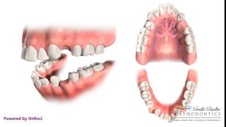 extraction of upper first premolar for orthodontic ttt [upl. by Rusell]