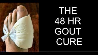 GOUTPODAGRATOPHIPSEUDOGOUT  48 HR CURE DISCOVERED FOR GOUT PODAGRATOPHI amp PSEUDOGOUT [upl. by Kincaid242]