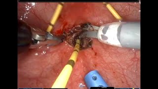 SinglePort RobotAssisted Transvesical Repair of a Vesicovaginal Fistula Graphic [upl. by Laeno]