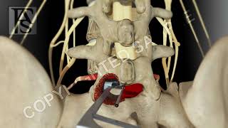 Lumbar Fusion of L5 S1 Hemilaminotomy [upl. by Anafetse]