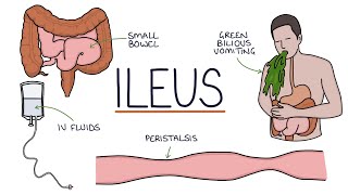 Understanding Ileus Paralytic Ileus [upl. by Sixel]