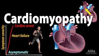 Cardiomyopathy animation [upl. by Roobbie]